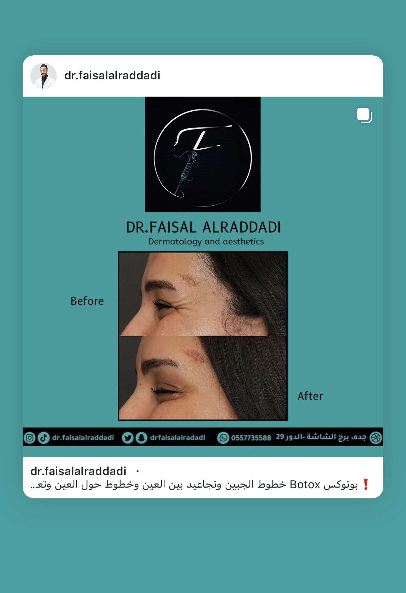 نتائج البوتوكس
