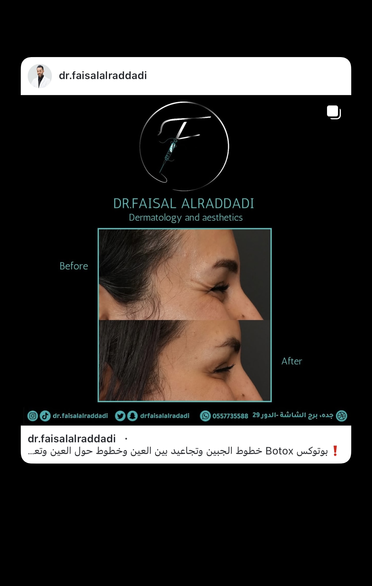 نتائج البوتوكس