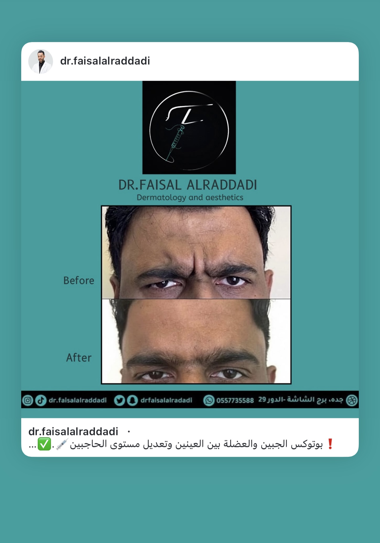 نتائج البوتوكس
