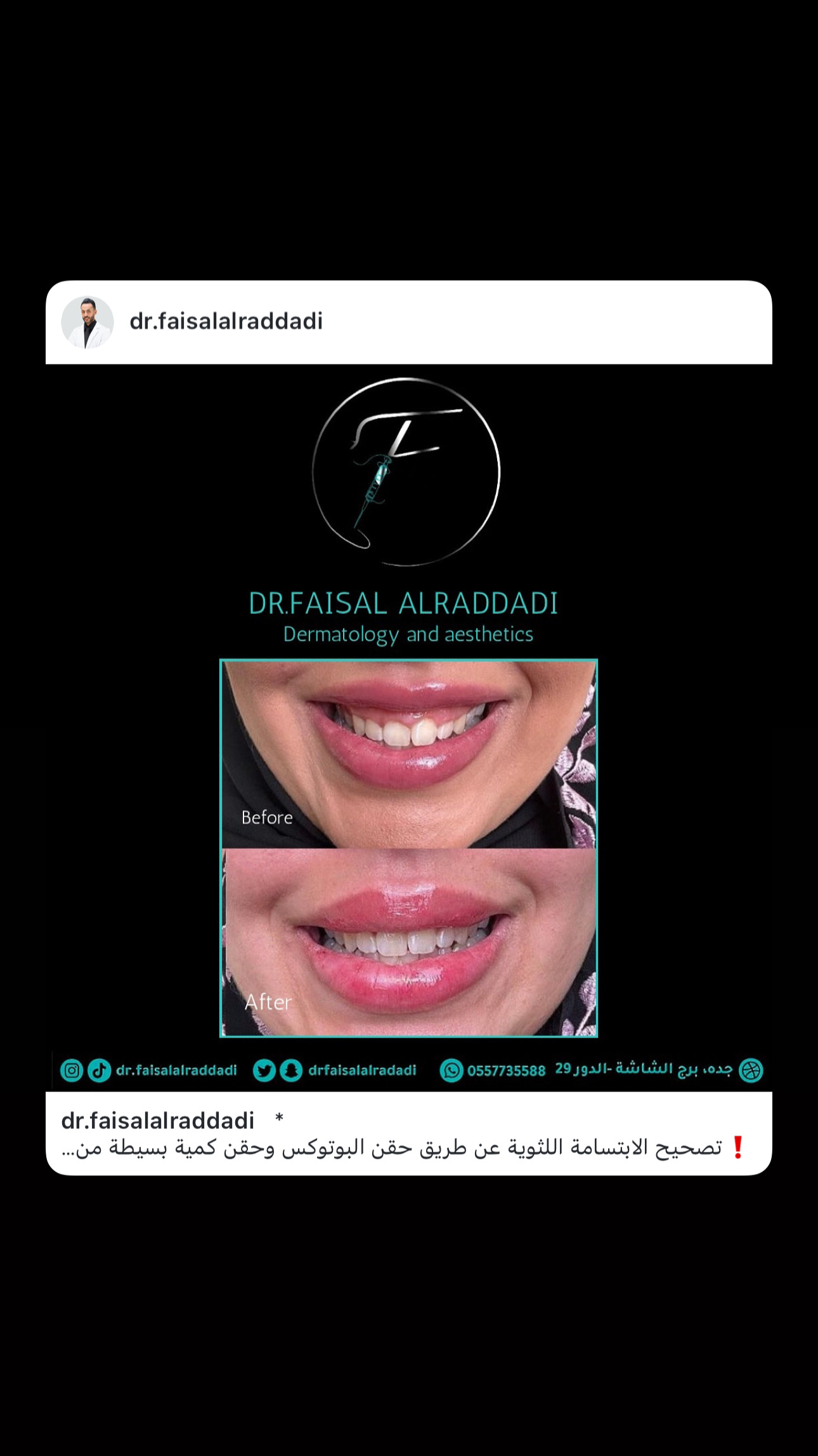 نتائج البوتوكس