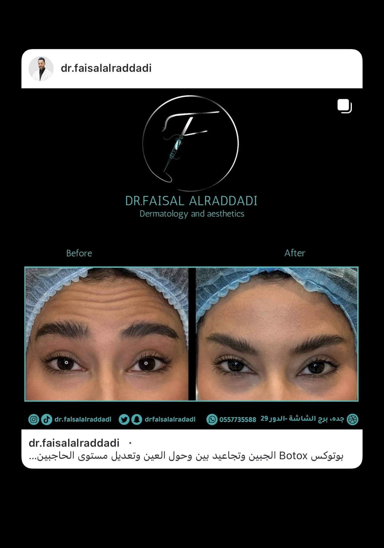 نتائج البوتوكس