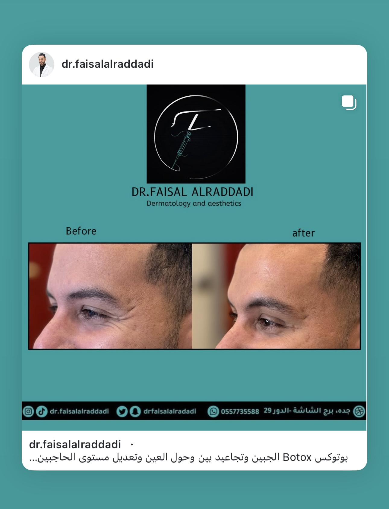نتائج البوتوكس