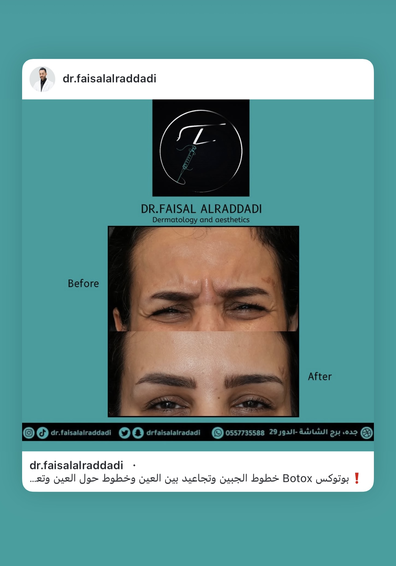 نتائج البوتوكس