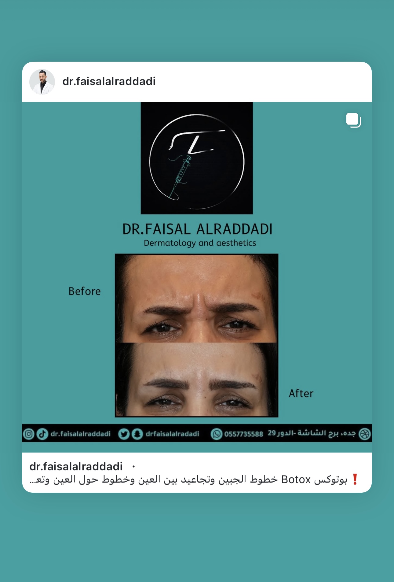 نتائج البوتوكس