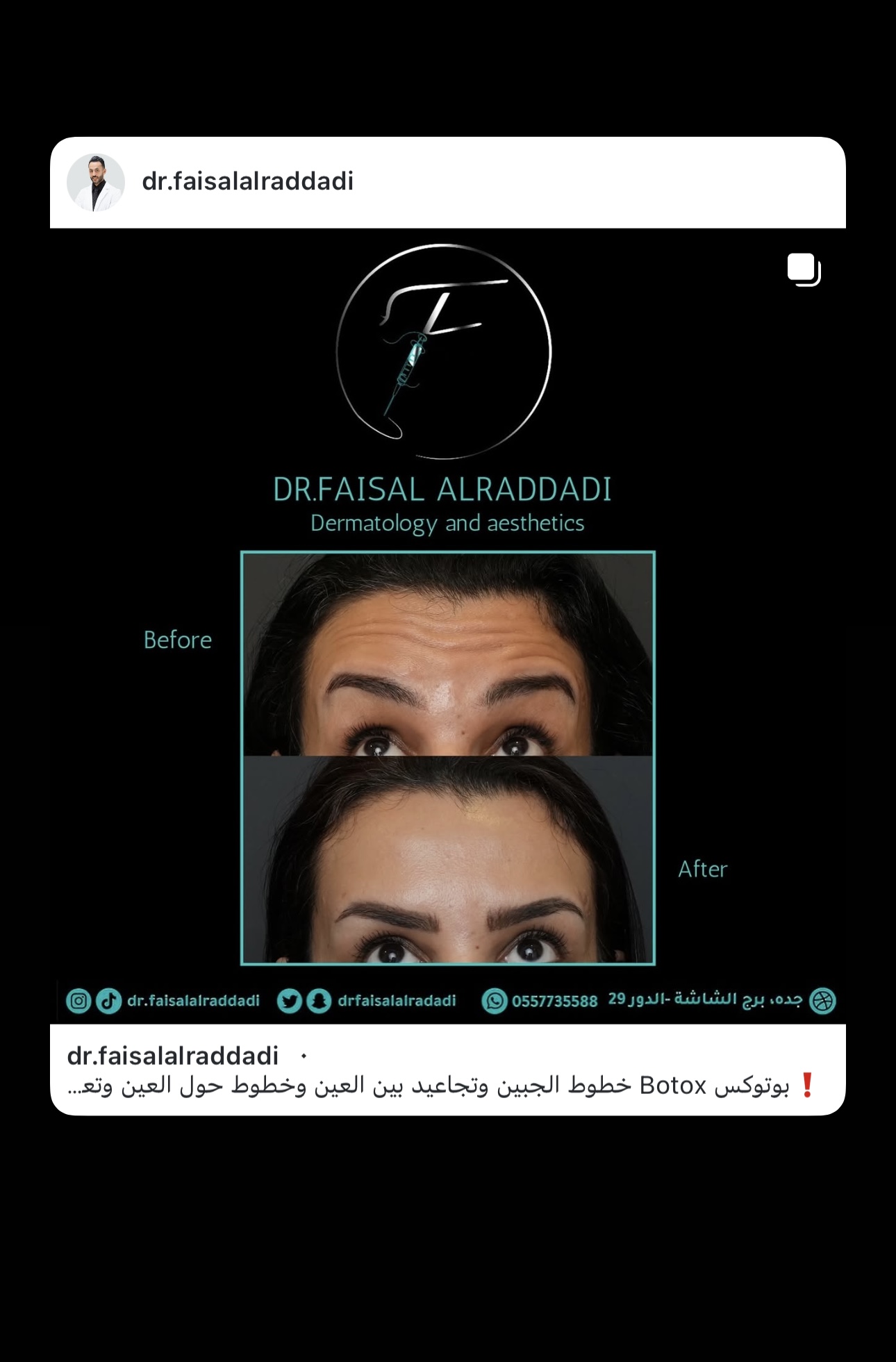 نتائج البوتوكس