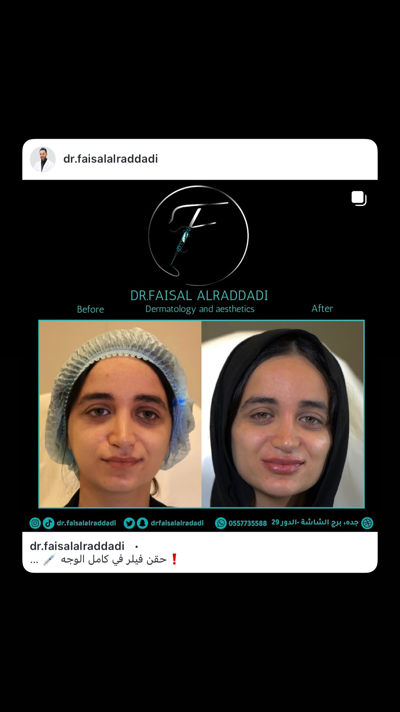 نتائج الفيلر