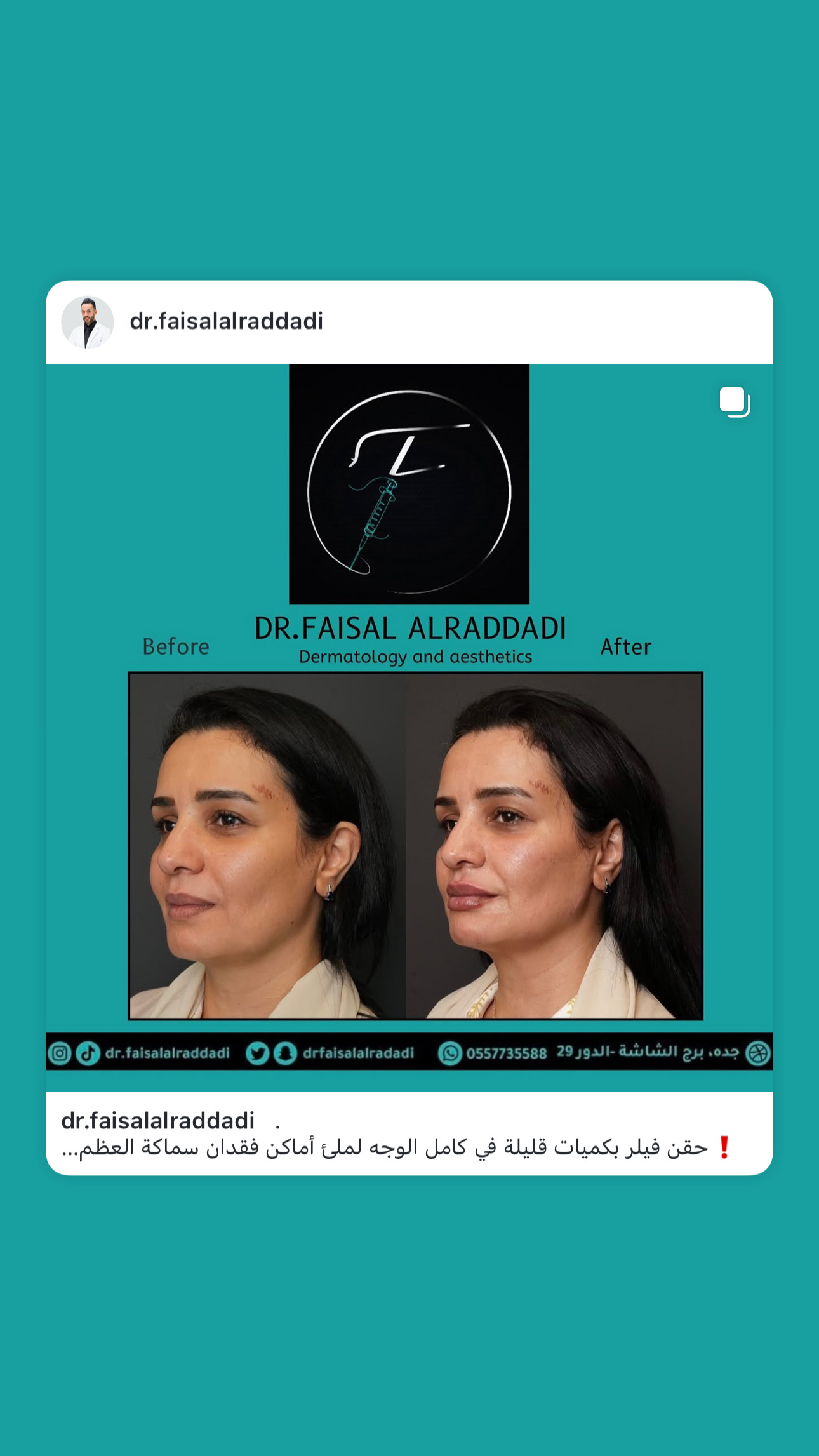 نتائج الفيلر