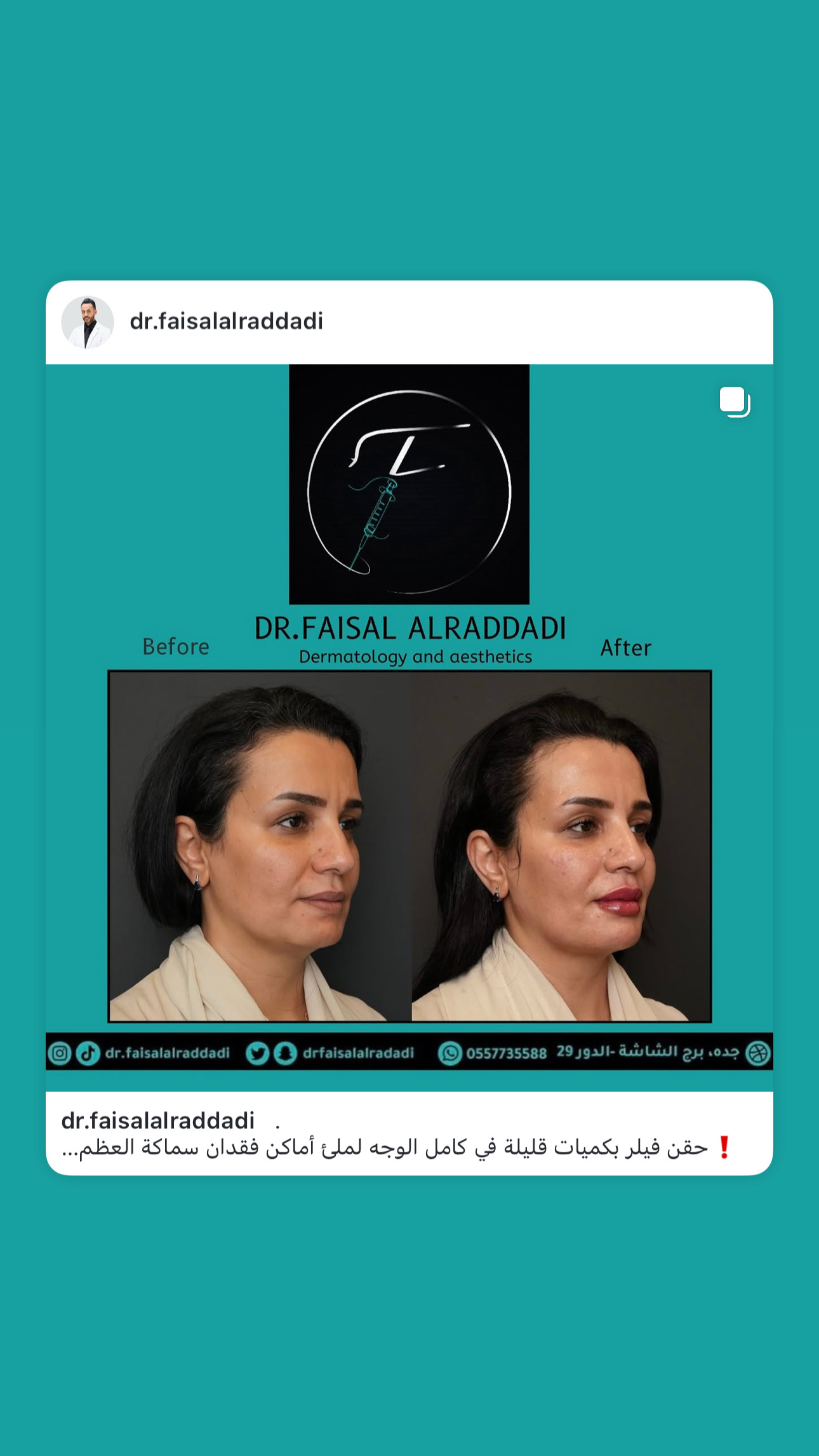 نتائج الفيلر