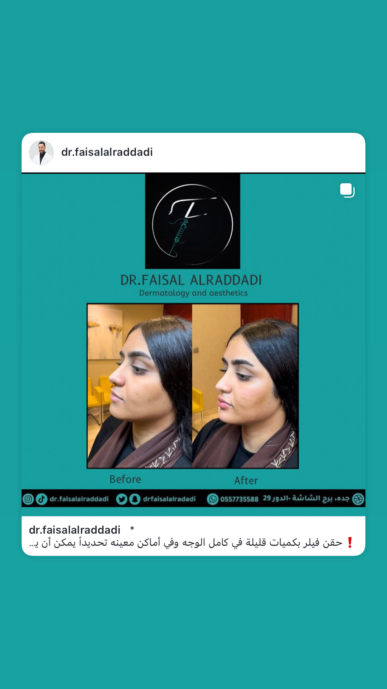 نتائج الفيلر
