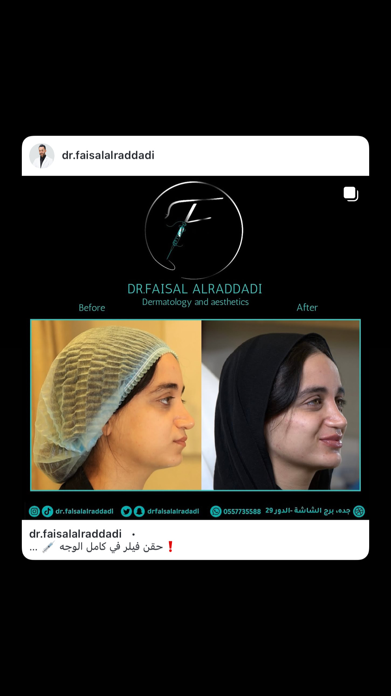 نتائج الفيلر