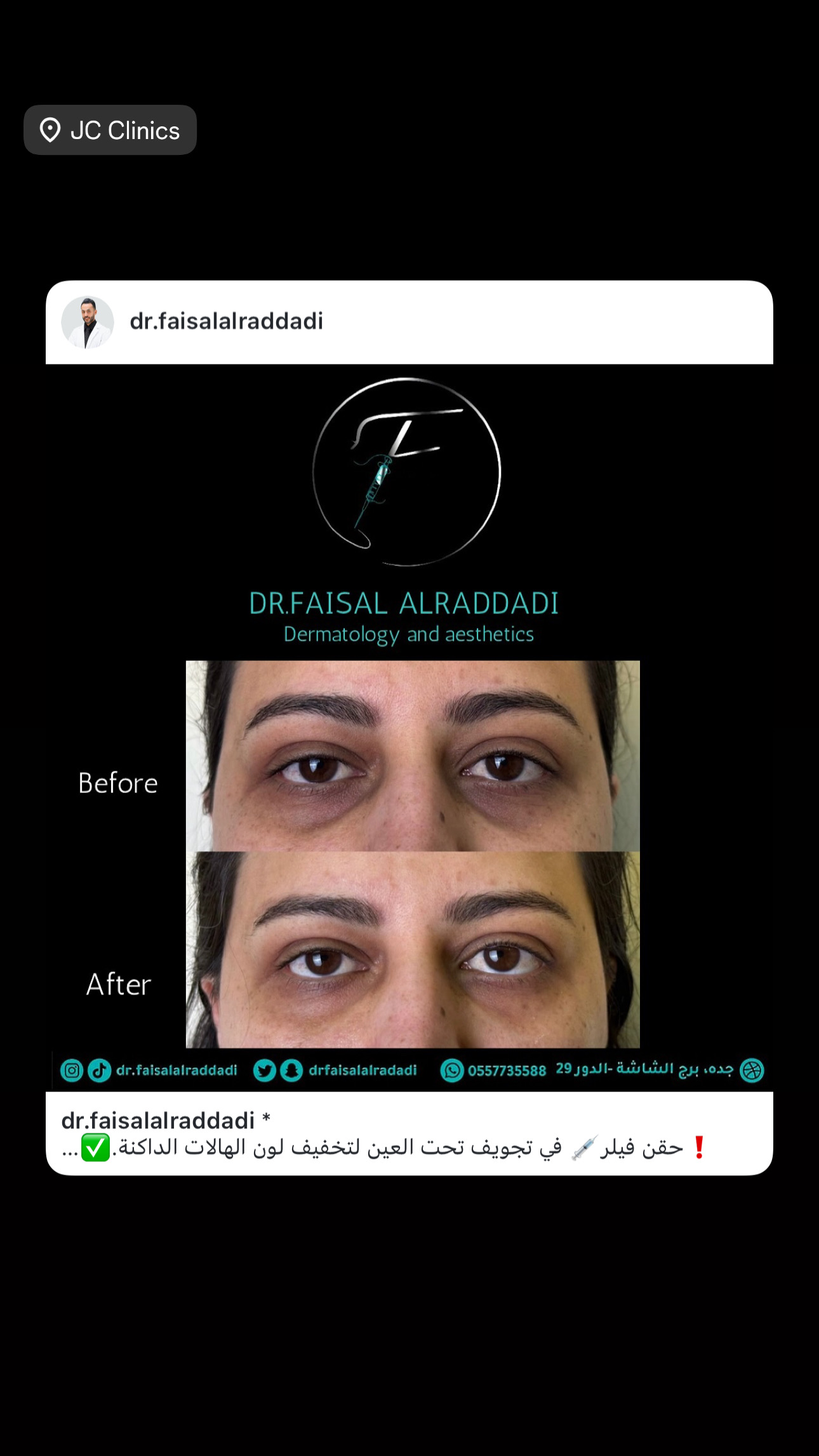 نتائج الفيلر