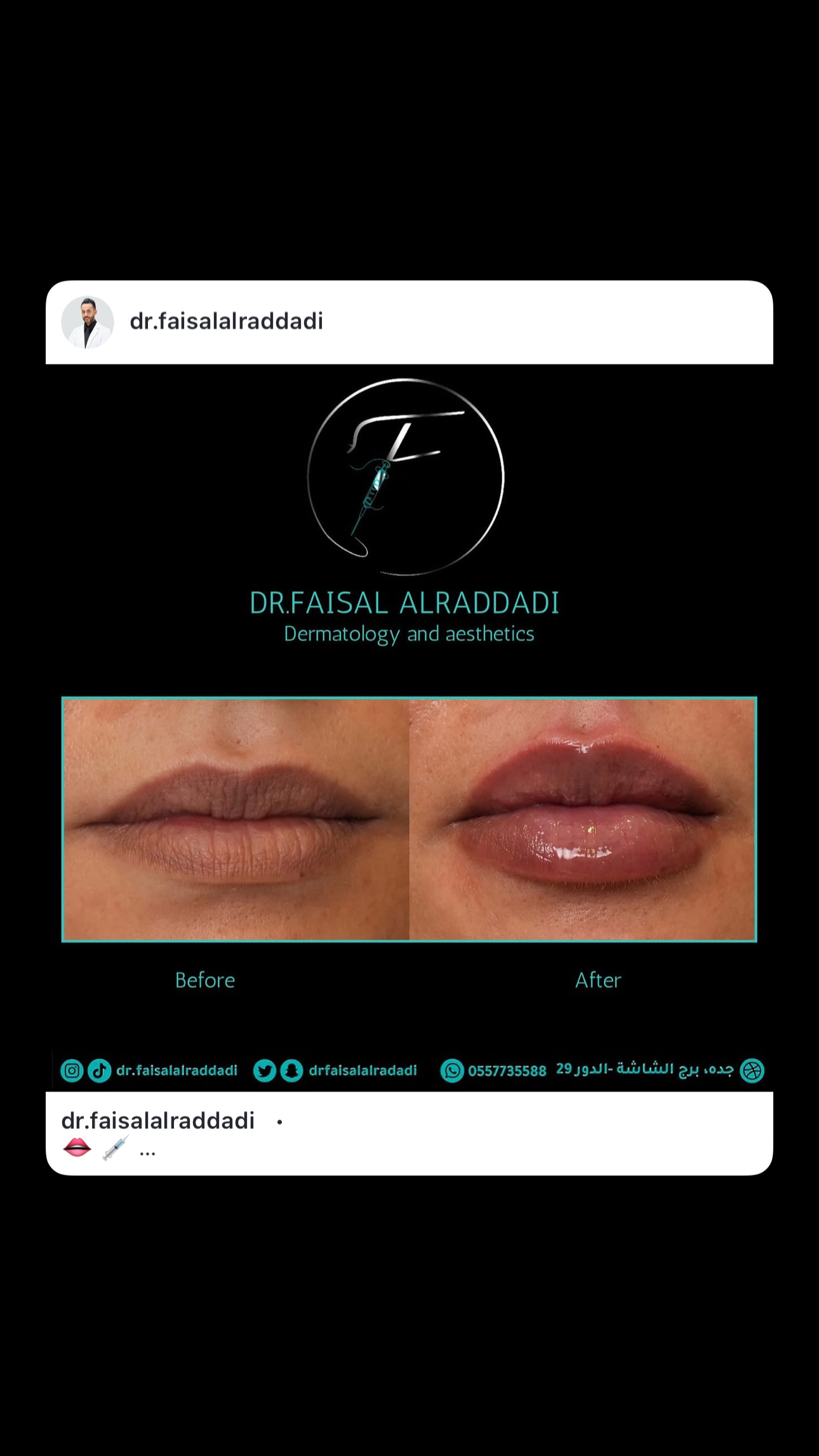 نتائج الفيلر