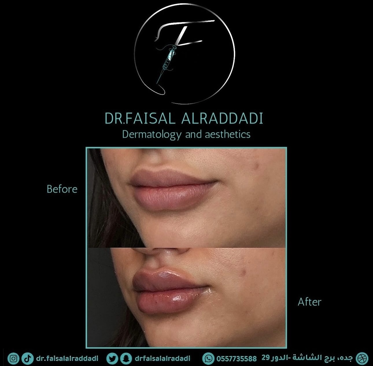 نتائج الفيلر