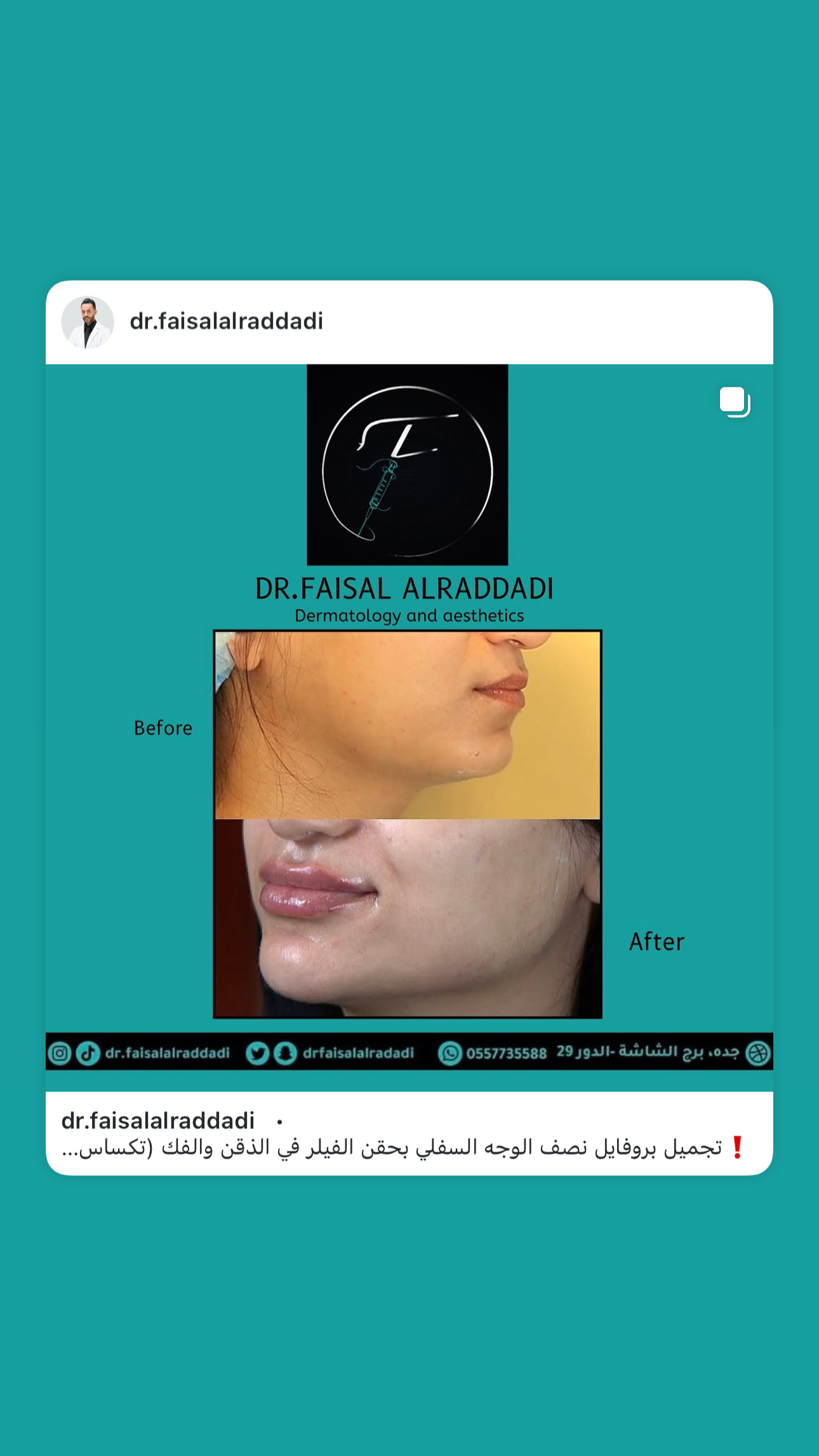 نتائج الفيلر