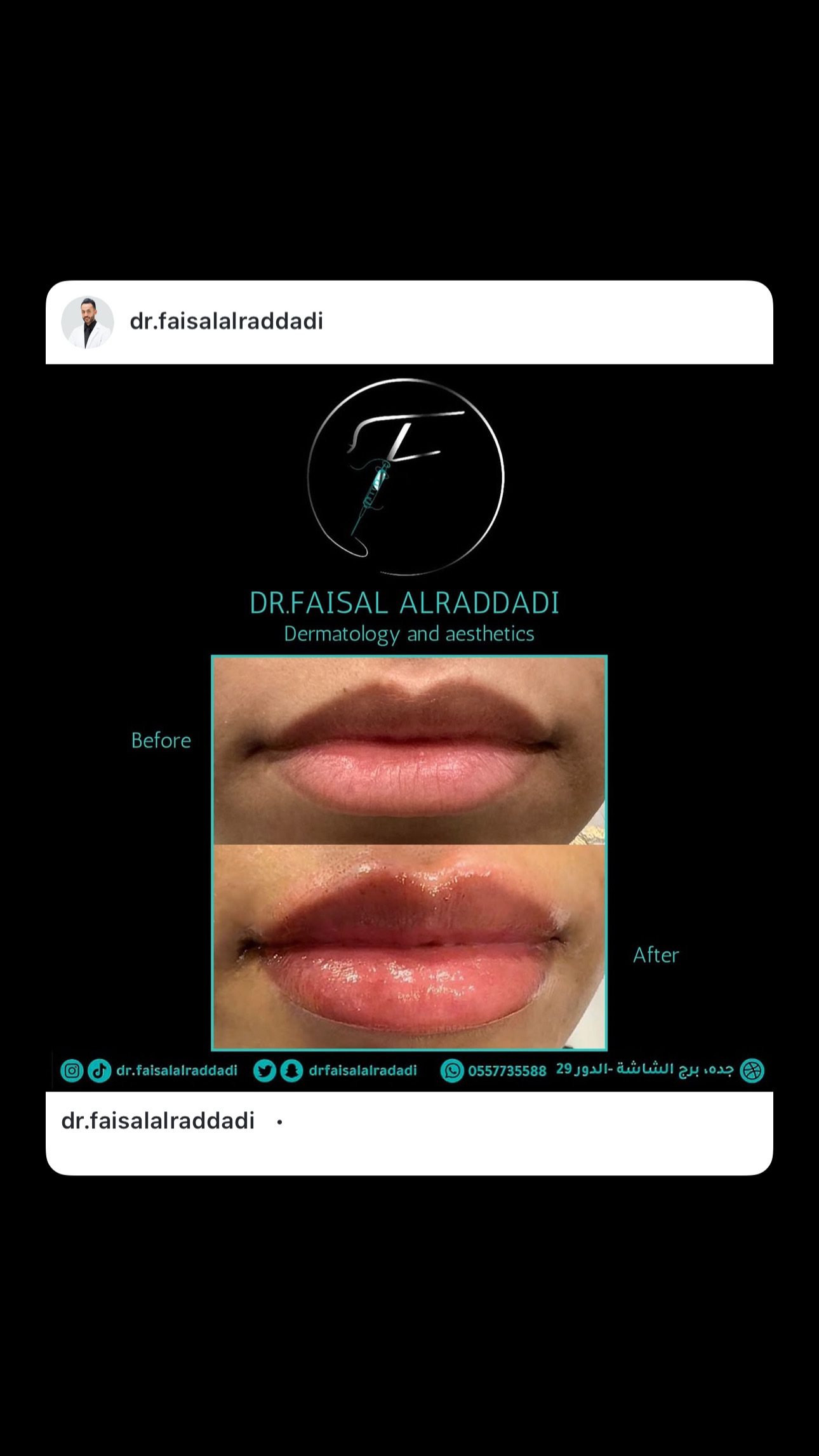 نتائج الفيلر