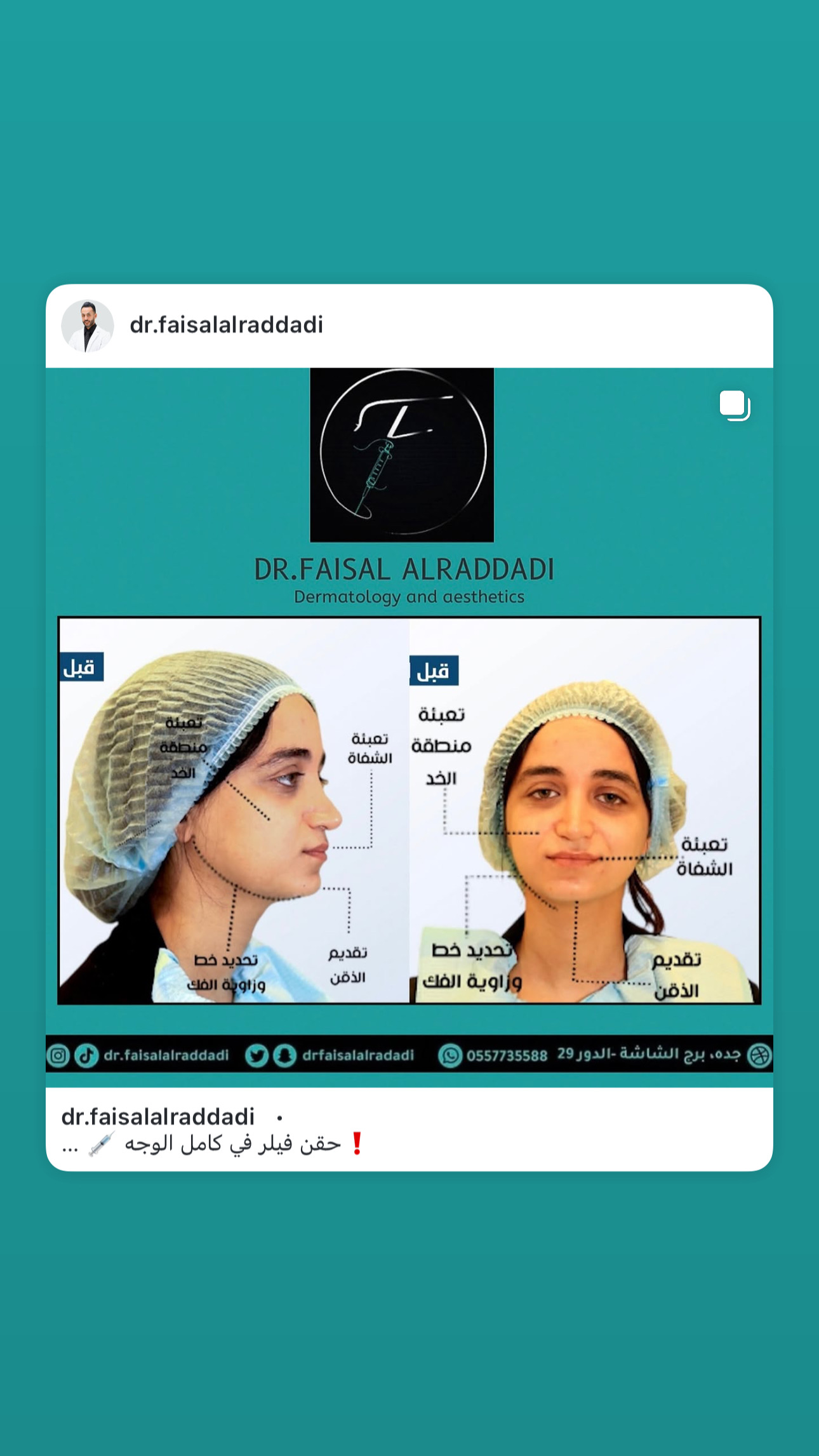 نتائج الفيلر