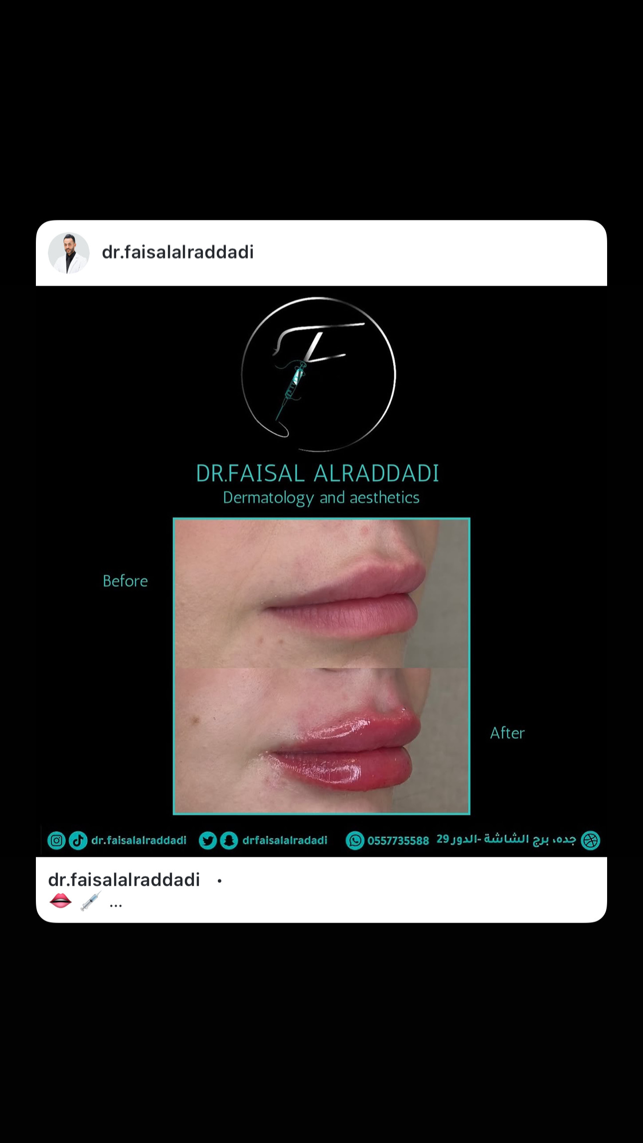 نتائج الفيلر