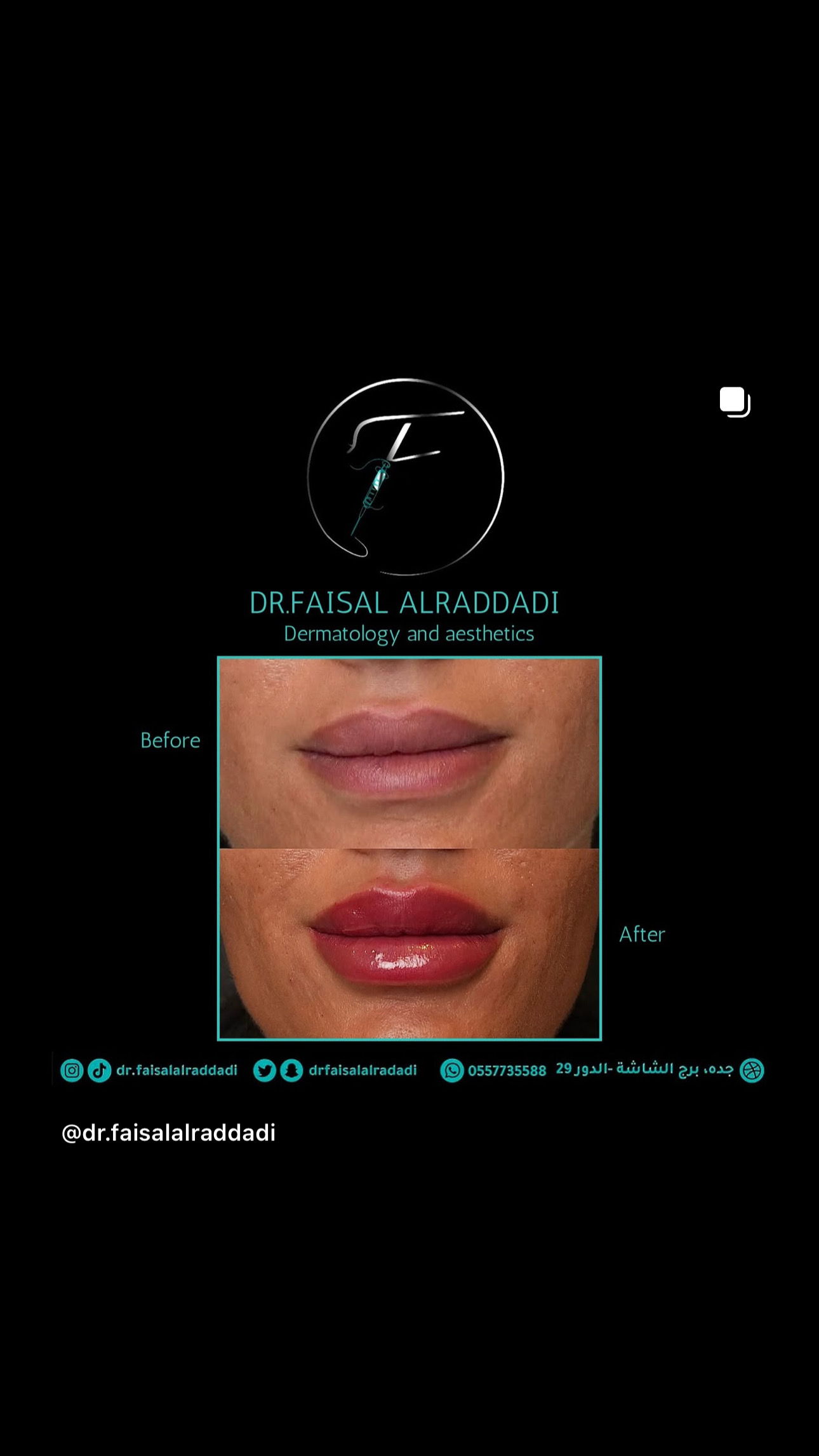 نتائج الفيلر