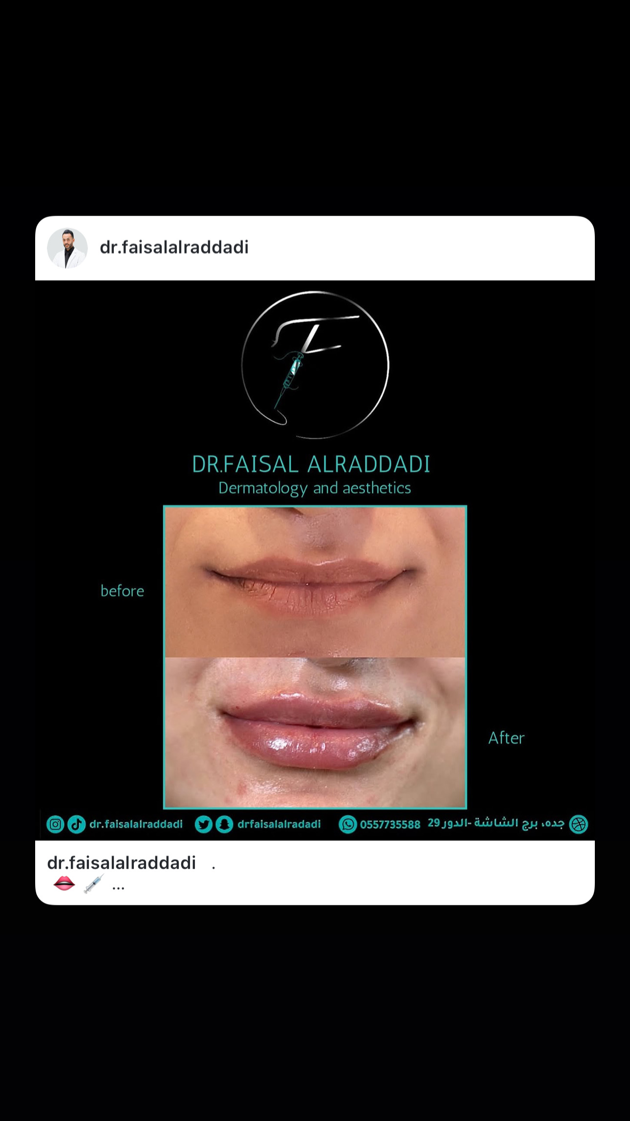 نتائج الفيلر