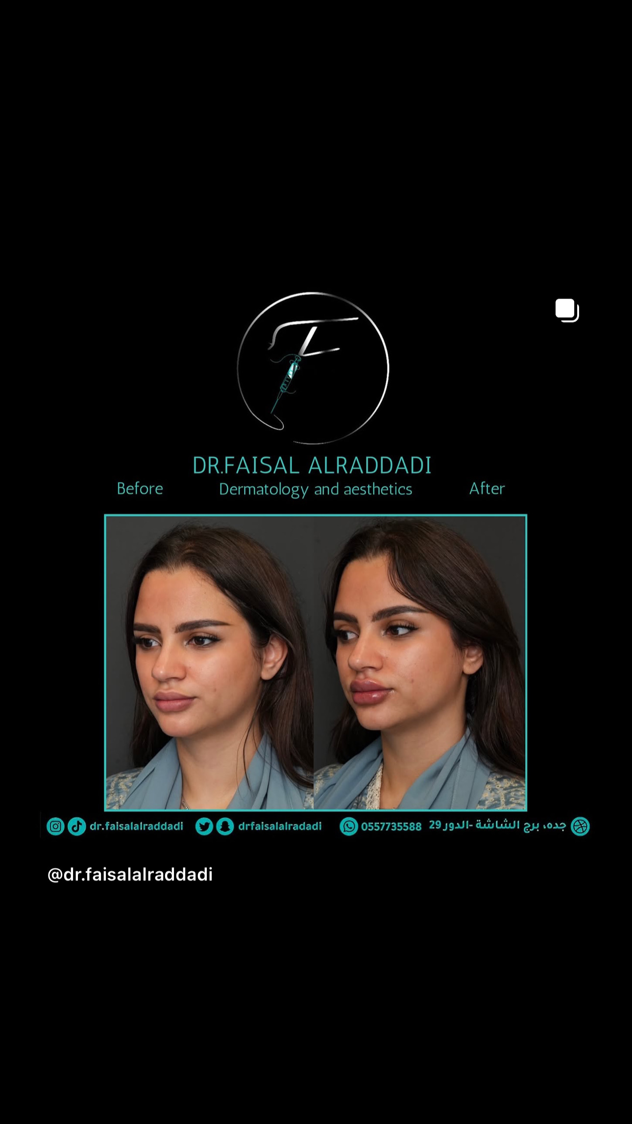 نتائج الفيلر