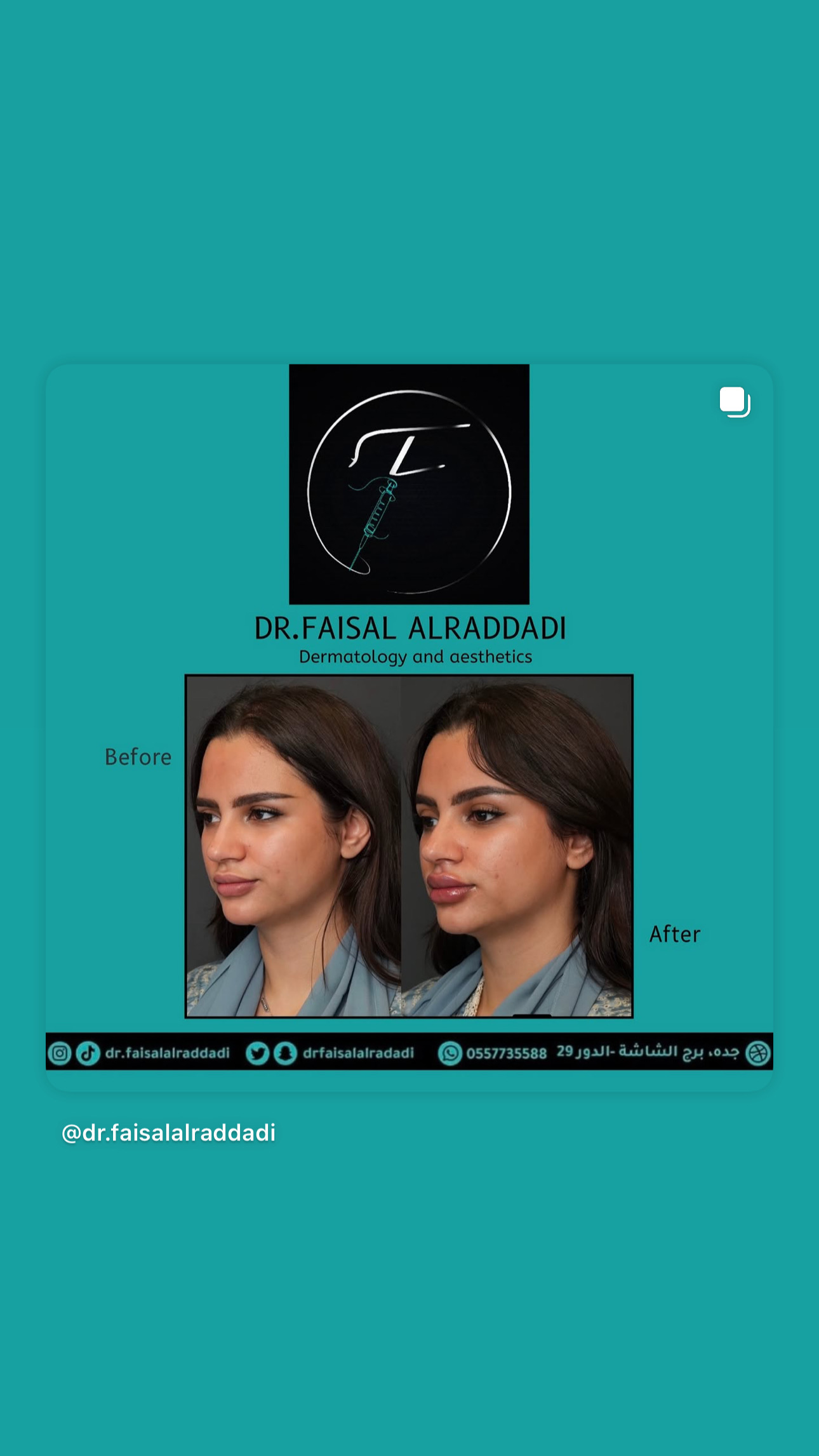 نتائج الفيلر