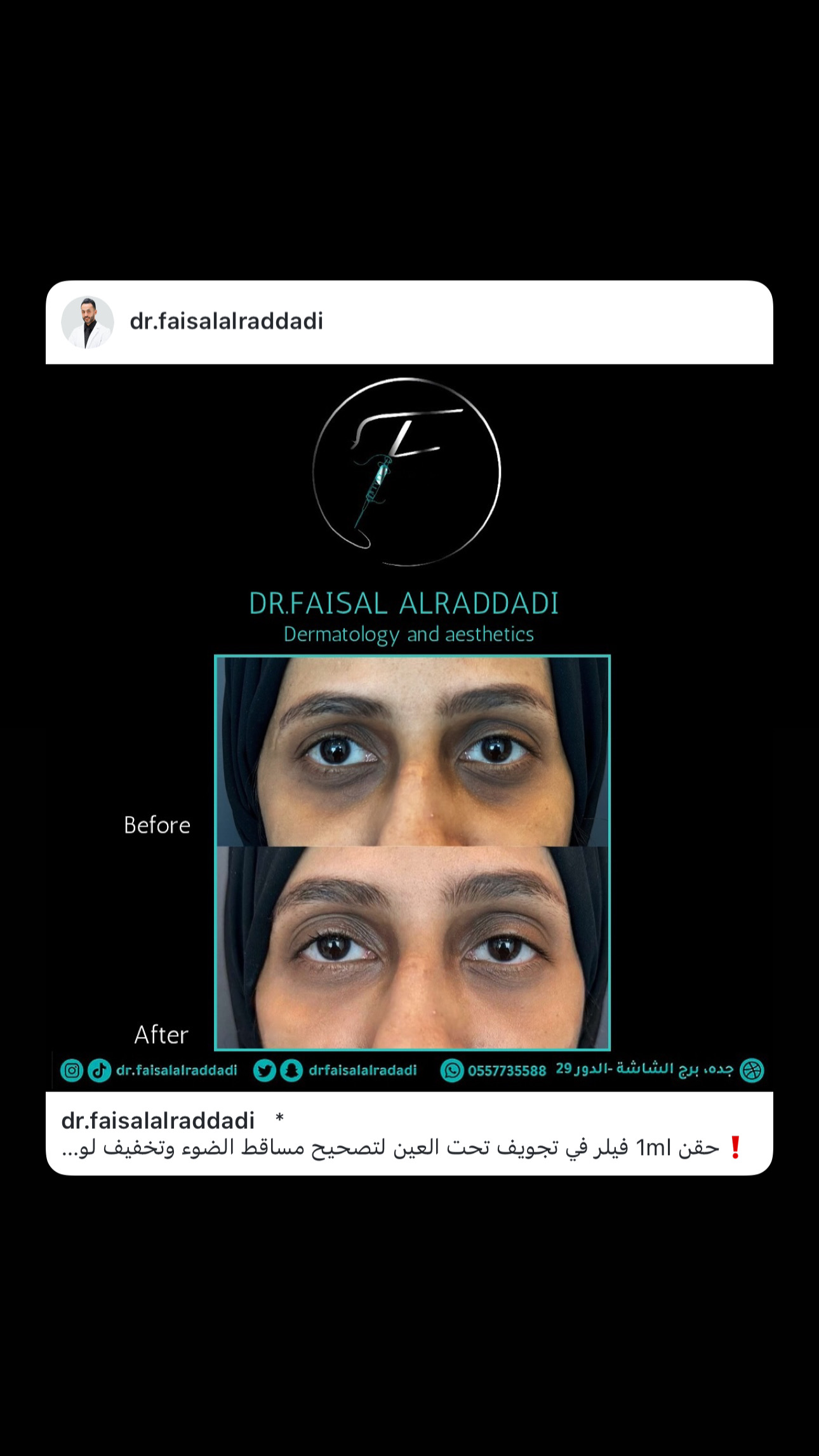 نتائج الفيلر
