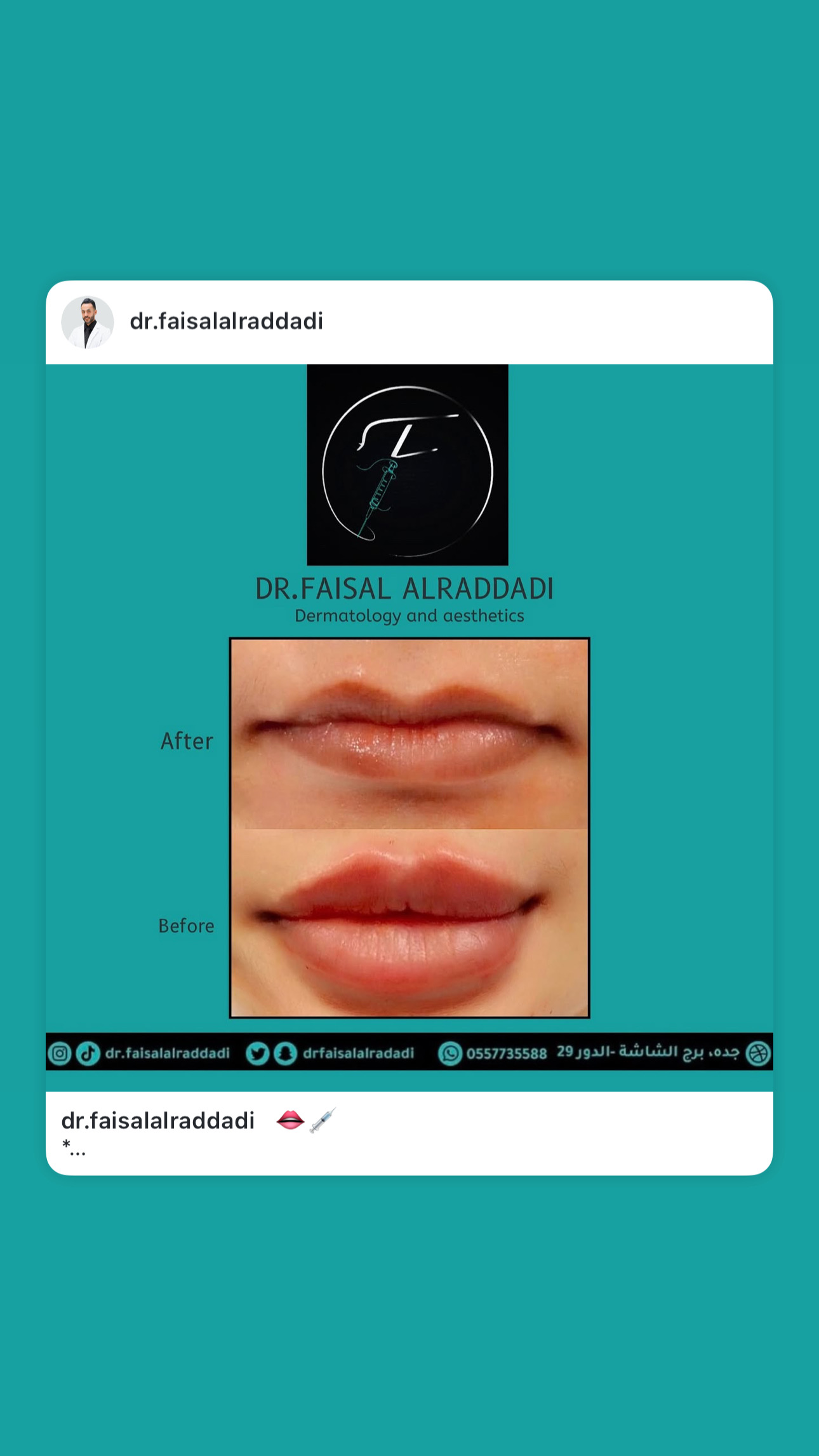 نتائج الفيلر